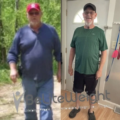 Weight Loss Surgery Before And After